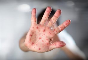 هشدار وزارت بهداشت درباره شیوع سرخک / فراخوان واکسیناسیون کودکان ایرانی و مهاجر زیر ۵ سال