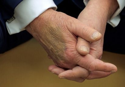 مشاهده دوباره کبودی بر روی دست ترامپ و افزایش گمانه زنی ها در باره سلامتی وی