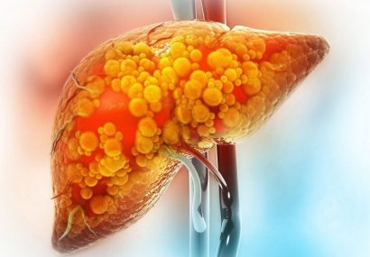 ضدحمله به کبدچرب؛ داروی جدید وارد میدان شد