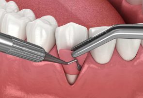 راهکار نانویی برای تسریع ترمیم و کاهش خطر عفونت جراحی دندان