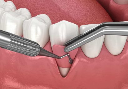 راهکار نانویی برای تسریع ترمیم و کاهش خطر عفونت جراحی دندان
